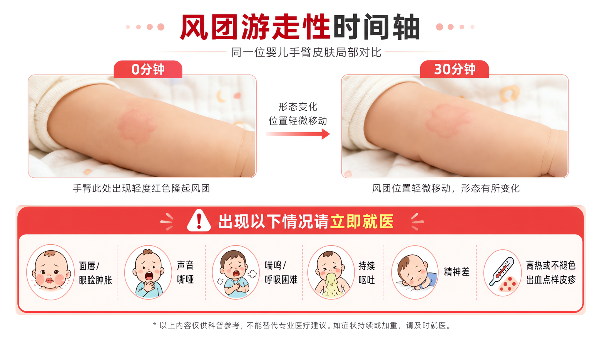 科普信息海报风格画面,白色干净背景,上半部分为“风团游走性时间轴”示意:同一位中国0-1岁婴儿的手臂