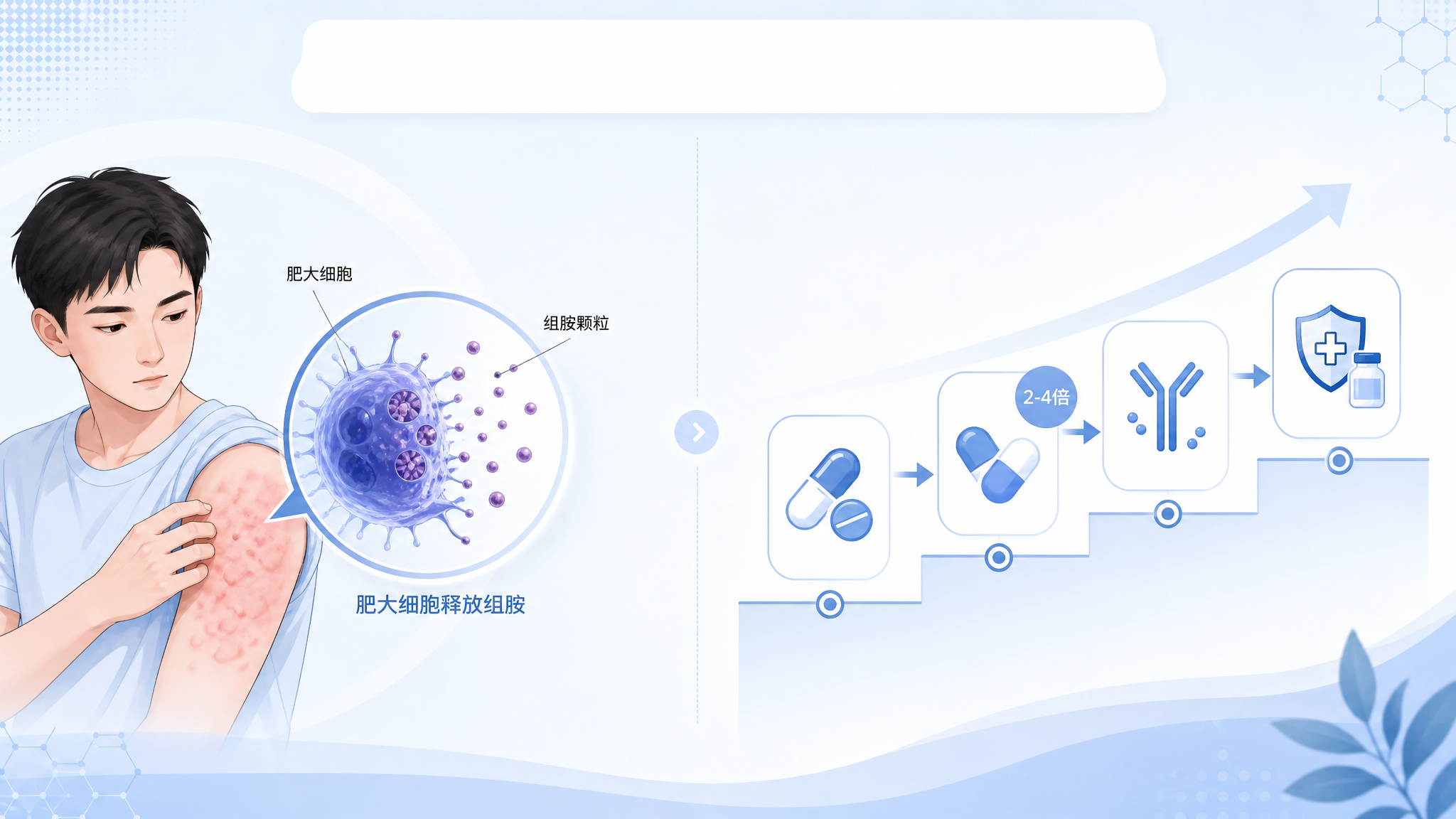 清爽医学科普风插画，画面分为左右两部分：左侧为“肥大细胞释放组胺”示意，中国成年人物上半身皮肤出现局部风团，右侧为常见的诱发因素图标与阶梯治疗提示，整体明亮、干净、专业