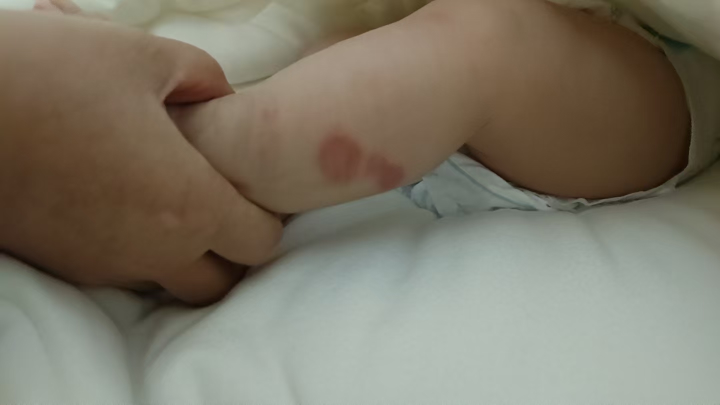 新生儿红屁屁急救指南｜从溃烂到痊愈只花3天