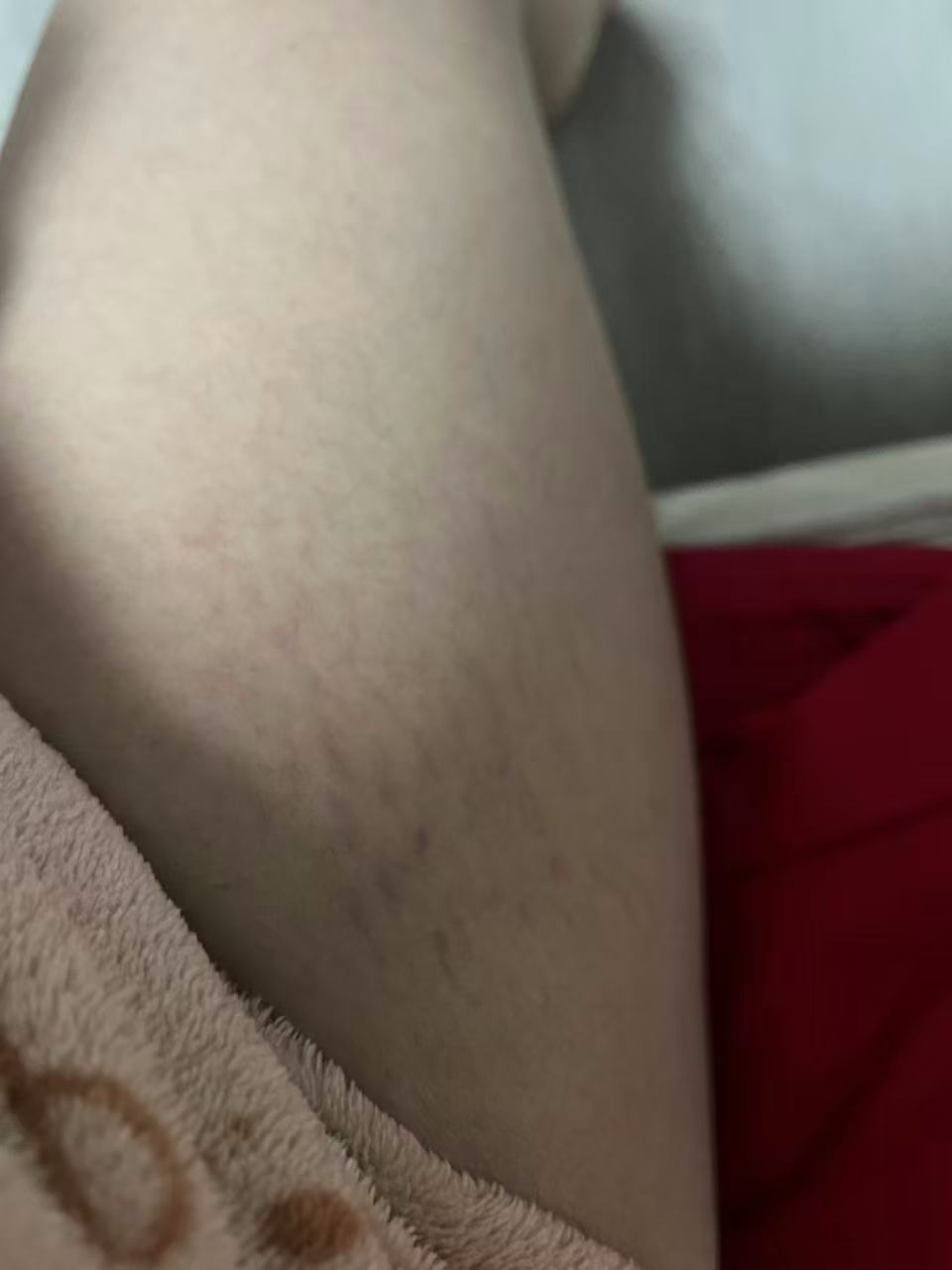 孕晚期妊娠纹突然长在大腿上