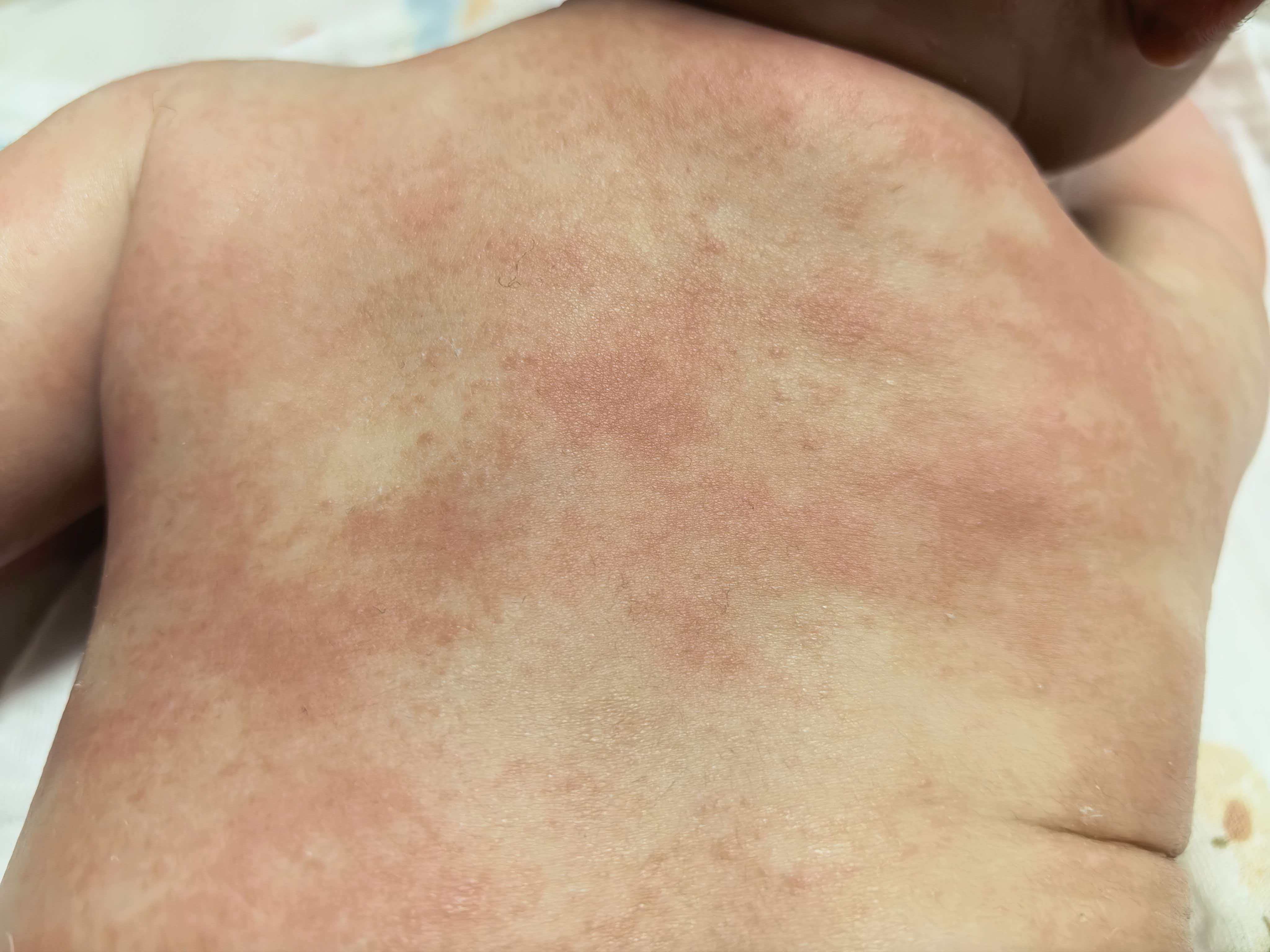 宝宝湿疹反复发作，求支招